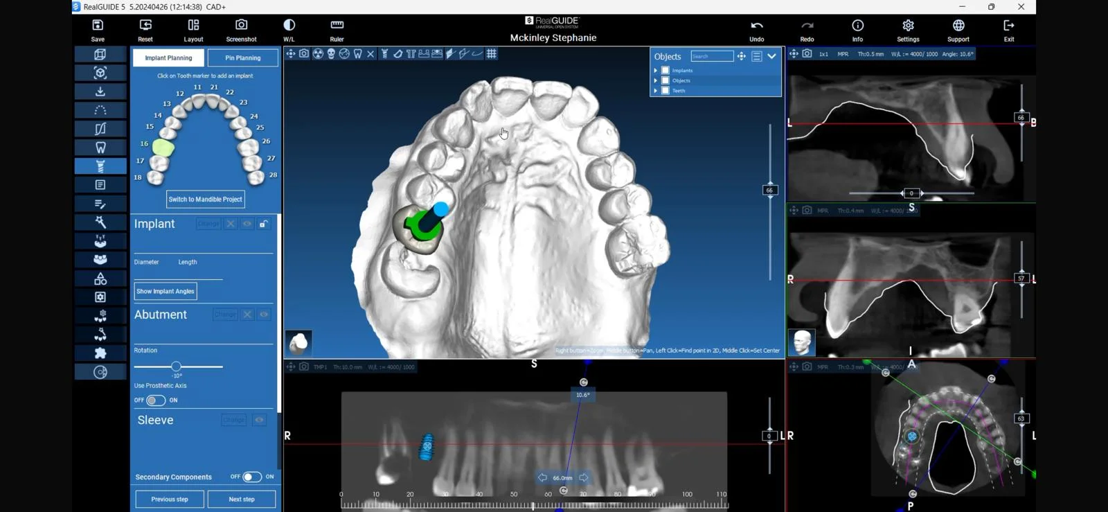 Digital Implant Planning