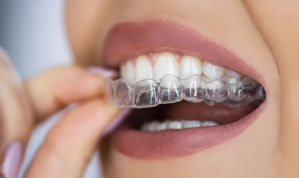 Clear Aligners
